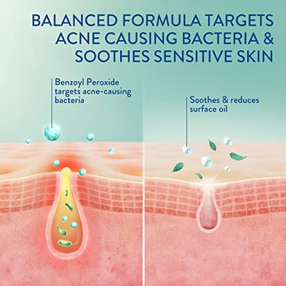 Cetaphil Gentle Clear Complexion Benzoyl Peroxide Acne Face Wash - 4.2 Fl Oz - Bellso