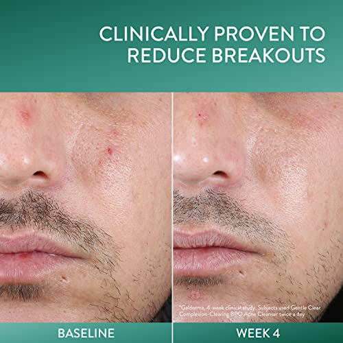 Cetaphil Gentle Clear Complexion Benzoyl Peroxide Acne Face Wash - 4.2 Fl Oz - Bellso